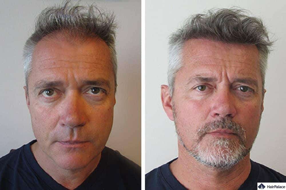 amazing hair transplant result